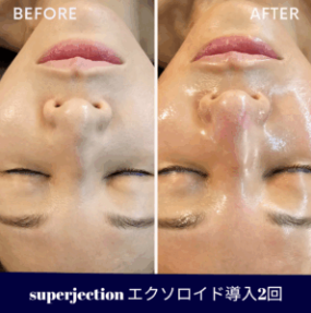 4. フェイシャルマッサージの効果的な組み合わせ